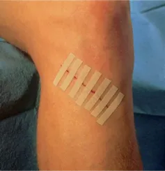 Ponto Falso Skin Strip Sutura 12 Tiras 6,4x76mm Skinupper - Imagem 2